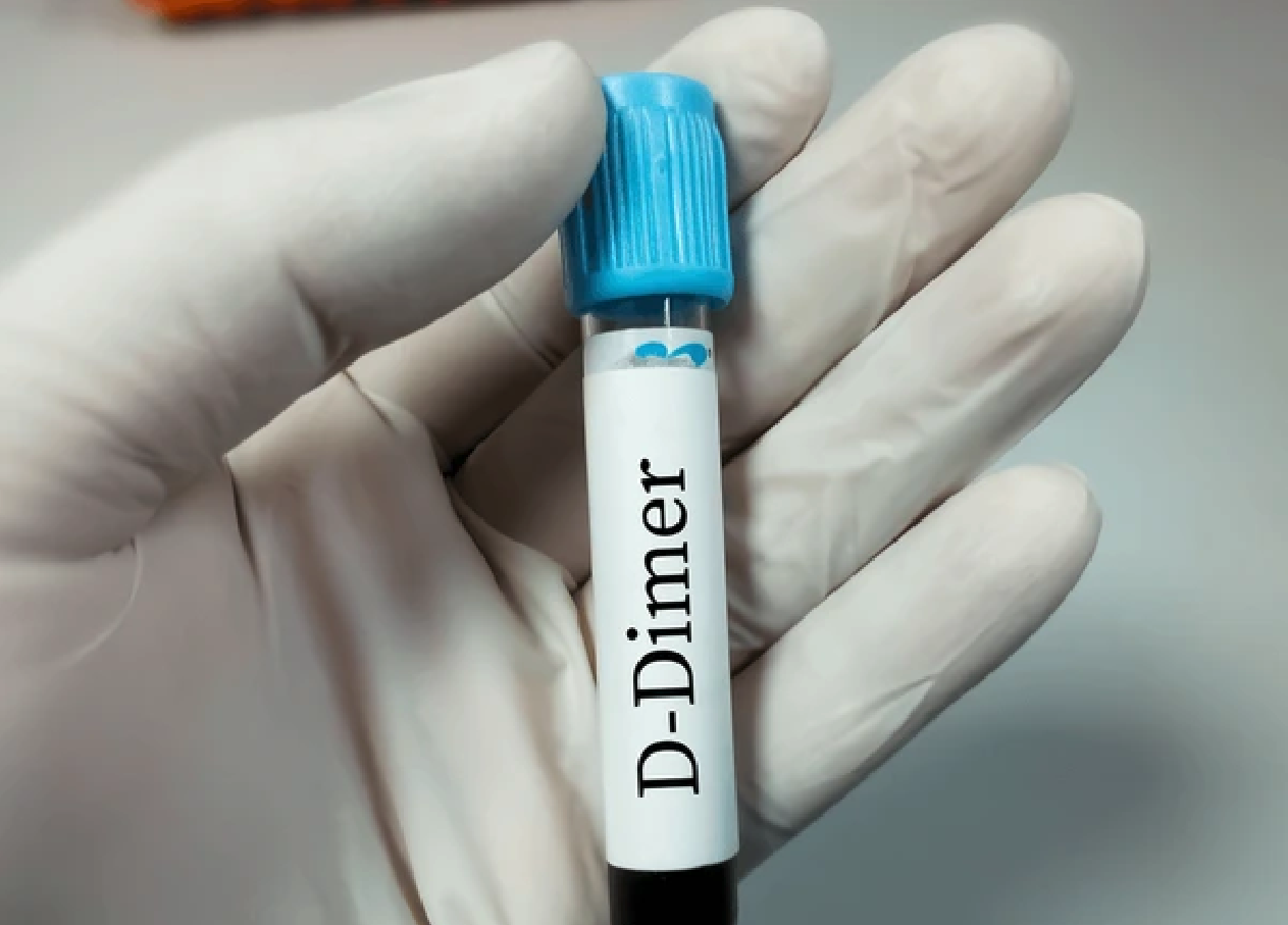 Rapid Growth Predicted for the D-Dimer Testing Market: Insights for Laboratory Professionals
